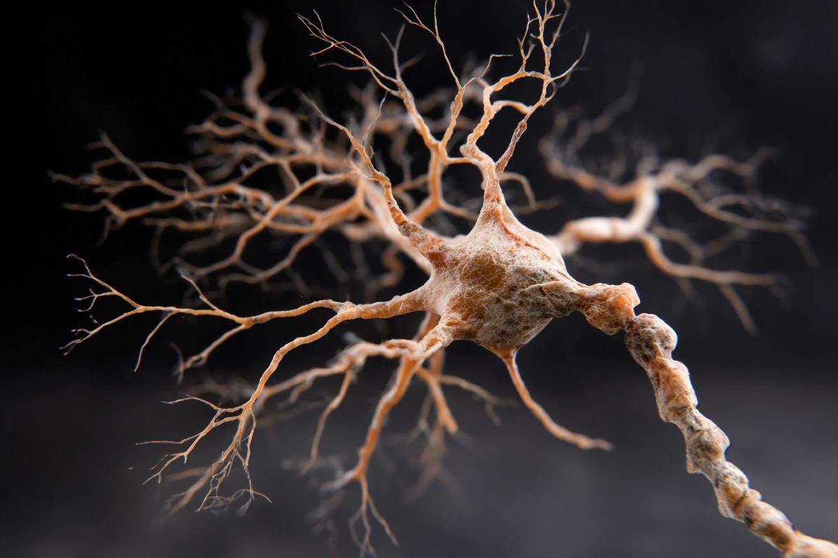 Alzheimer’s Risk Gene May Drive Aggressive ALS