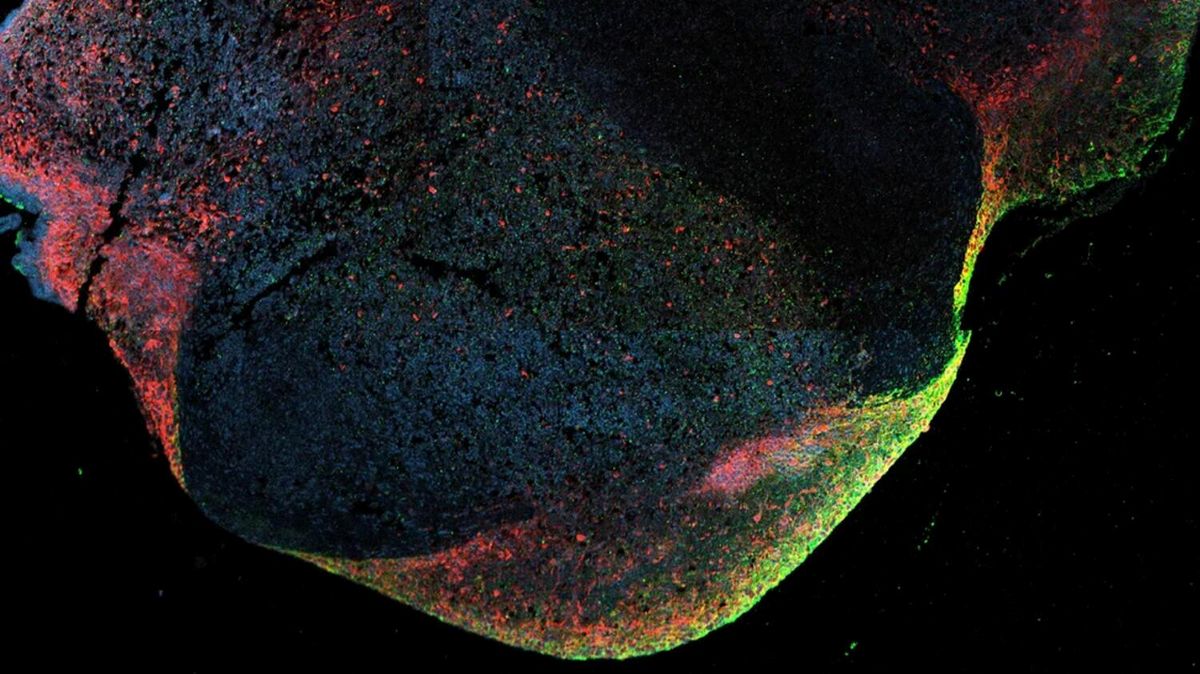 Ebola Maintains Active Persistence Inside Human Brains